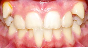 Before & After - McDonald Orthodontics