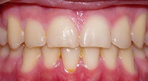 Before & After - McDonald Orthodontics