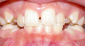 Before & After - McDonald Orthodontics