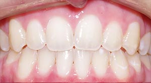 Before & After - McDonald Orthodontics