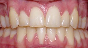 Before & After - McDonald Orthodontics