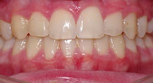 Before & After - McDonald Orthodontics