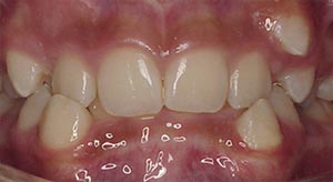 Before & After - McDonald Orthodontics