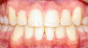 Before & After - McDonald Orthodontics