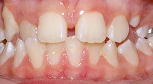 Before & After - McDonald Orthodontics