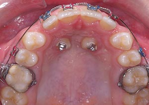 Before & After - McDonald Orthodontics
