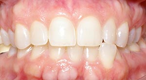 Before & After - McDonald Orthodontics