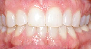 Before & After - McDonald Orthodontics