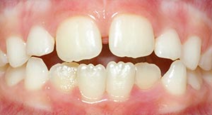 Before & After - McDonald Orthodontics