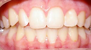 Before & After - McDonald Orthodontics