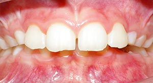 Before & After - McDonald Orthodontics