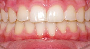 Before & After - McDonald Orthodontics