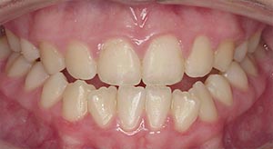Before & After - McDonald Orthodontics
