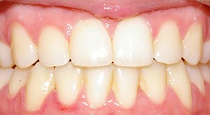 Before & After - McDonald Orthodontics