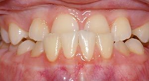 Before & After - McDonald Orthodontics