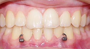 Before & After - McDonald Orthodontics