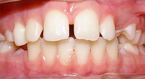 Before & After - McDonald Orthodontics