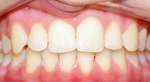 Before & After - McDonald Orthodontics